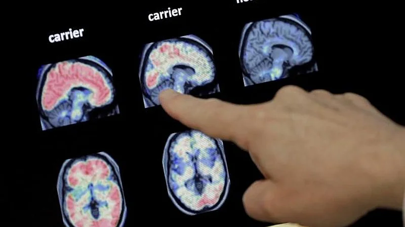 Implante cerebral devuelve el habla a un paciente con parálisis grave desde su casa