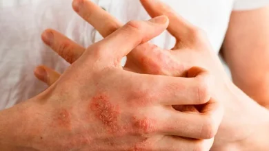 Dermatitis atópica: enfermedad que roba el sueño y dispara ansiedad y ausentismo