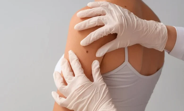 Moderna y Merck anuncian resultados positivos de una vacuna contra el cáncer de piel