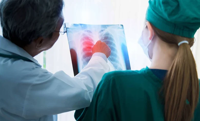 Diagnóstico temprano del cáncer de pulmón: lo que debe saber para cuidar su salud