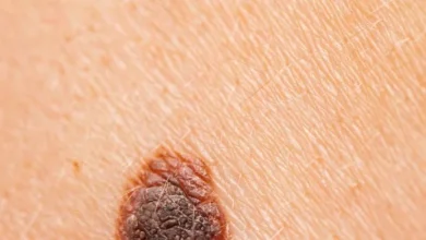Vacuna personalizada contra el melanoma reduce 42 % el riesgo de recurrencia o muerte