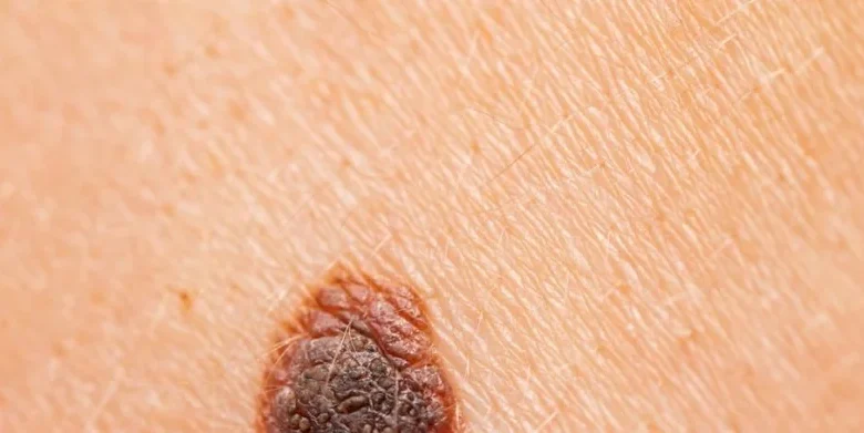 Vacuna personalizada contra el melanoma reduce 42 % el riesgo de recurrencia o muerte