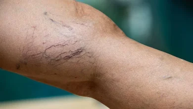 Varices no son solo estética: cirujano vascular alerta sobre riesgos y cuándo buscar ayuda