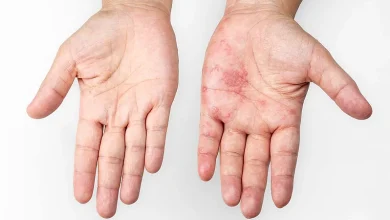 Científicos alemanes recrean en organoides cómo el herpes simple tipo 1 se propaga por la piel